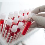 LDH, Fluid (Lactic dehydrogenase Fluid)