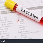 CA15.3 (Breast Cancer)