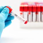 CEA (Carcino Embryonic Antigen)