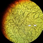 Koh For Fungus