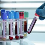 Calcium, 24Hrs.Urine