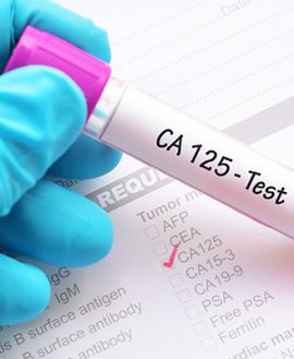 CA125 (Ovarian Cancer)