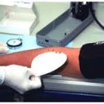 Bleeding Time (B.T)