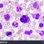 Peripheral Blood Smear